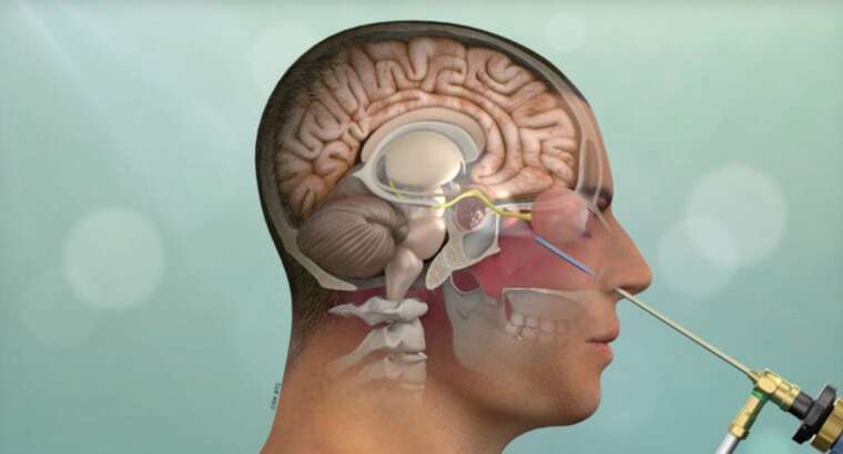 Types of Brain Surgery