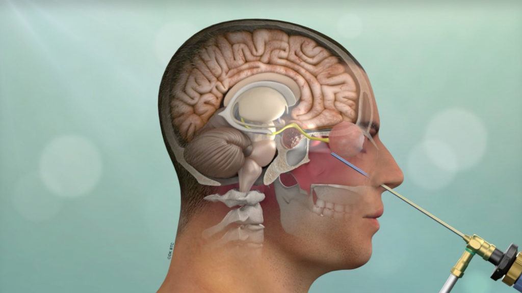 Types of Brain Surgery