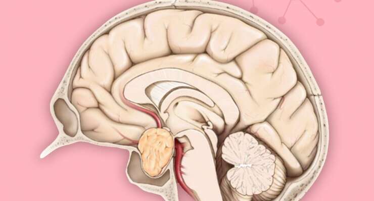 Pitutary Tumor