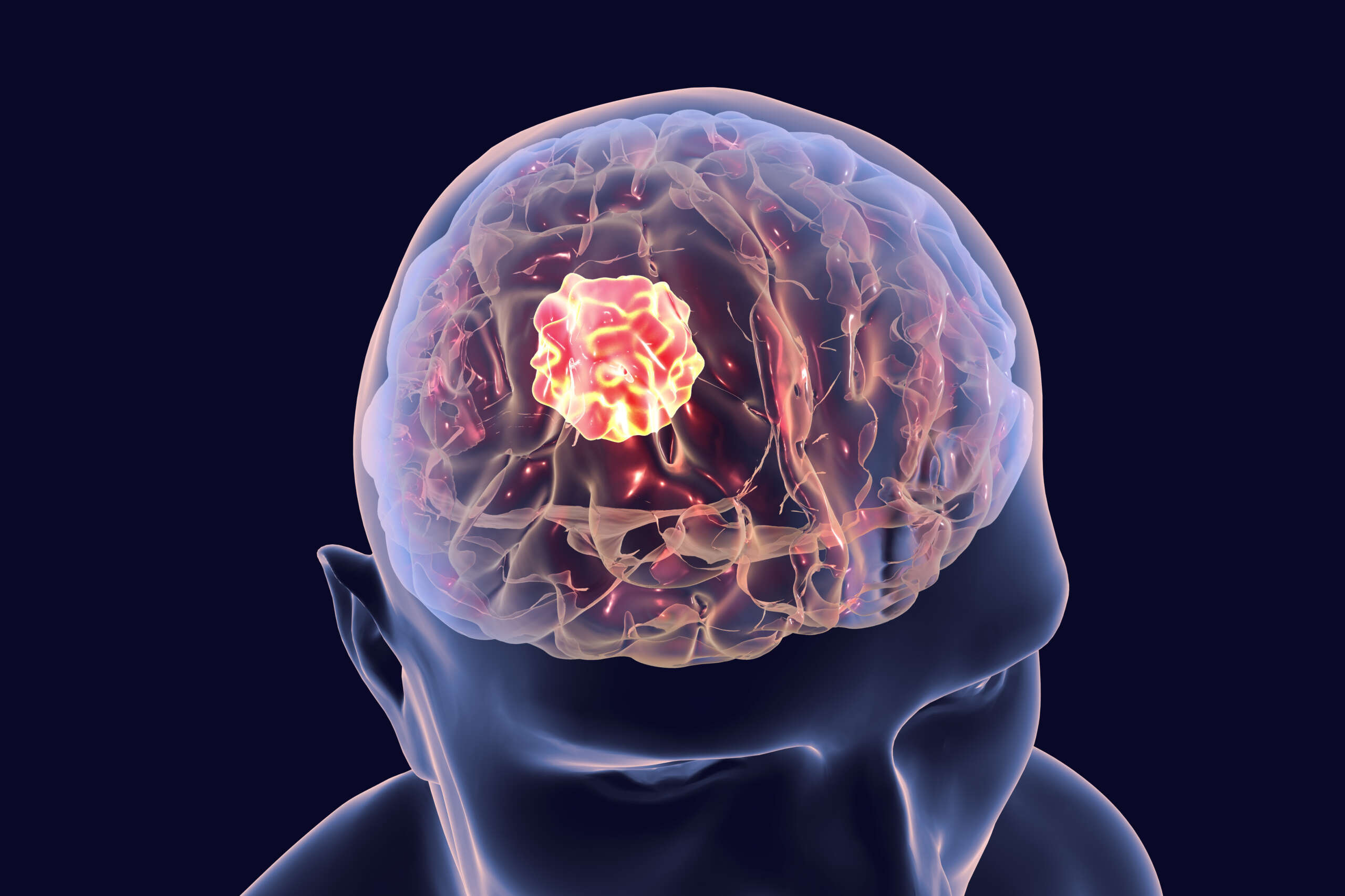 The Importance of Early Detection- Brain Tumor Screening and Diagnosis