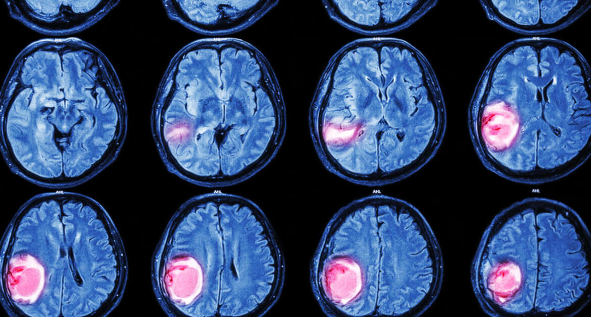 Treatment Approaches for Brain Tumors- Surgery, Radiation and Chemotherapy