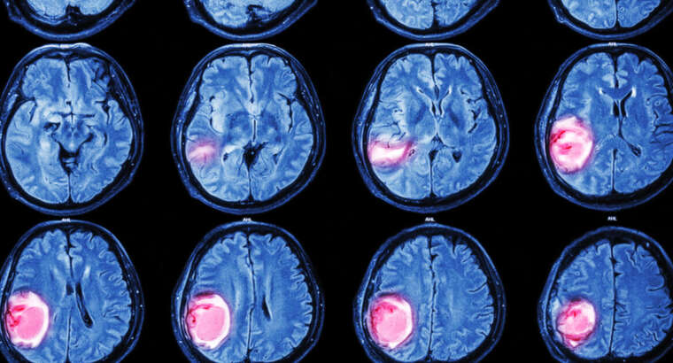 Treatment Approaches for Brain Tumors- Surgery, Radiation and Chemotherapy